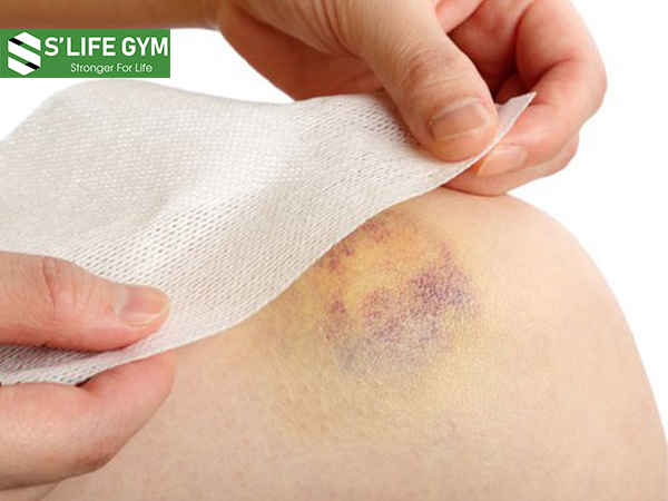 Dấu hiệu tăng đường huyết: Có vết bầm bất thường trên da