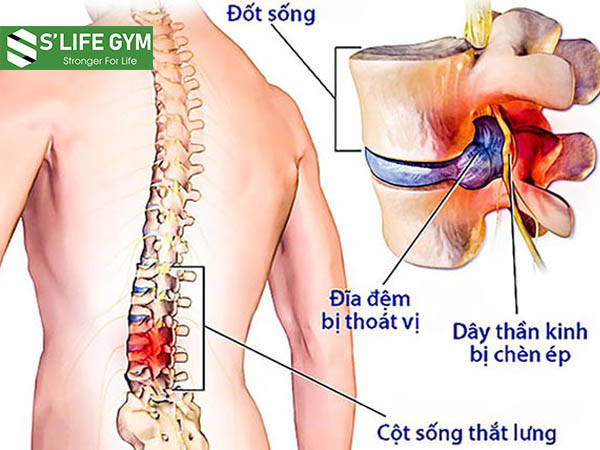Những bệnh nhân bị thoát vị đĩa đệm thường đau nhức vùng thắt lưng, cổ