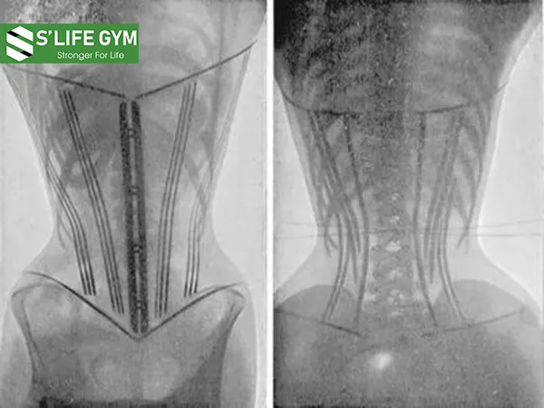 Sử dụng gen nịt bụng lâu làm ảnh hưởng cấu trúc xương
