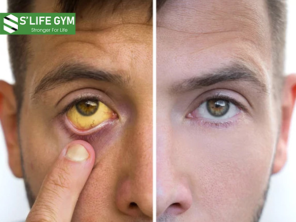 Dấu hiệu thiếu vitamin: Lòng trắng của mắt bị vàng