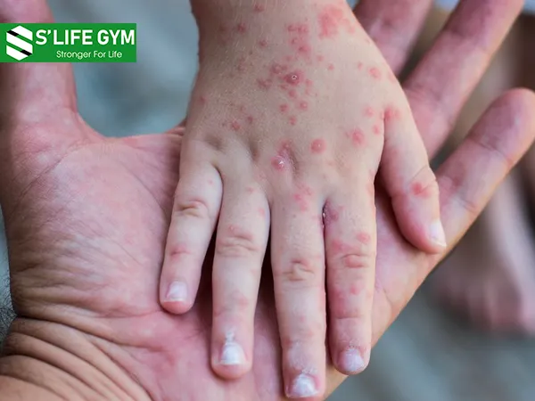 Dấu hiệu thiếu vitamin: những vết mẩn đỏ ở mu bàn tay và hông